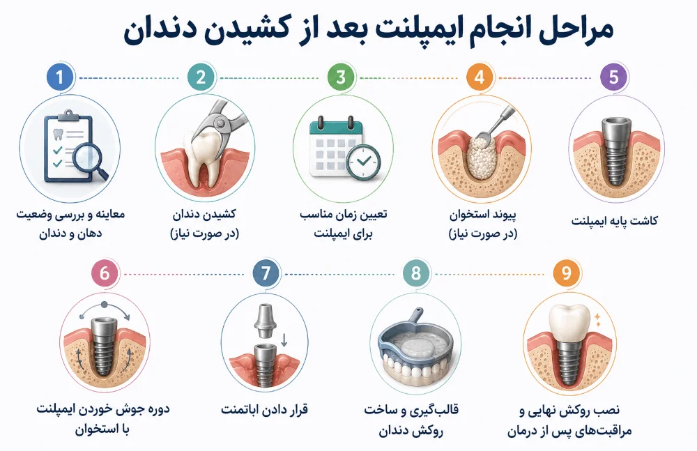 مراحل انجام ایمپلنت بعد از کشیدن دندان