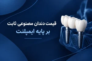 قیمت دندان مصنوعی ثابت بر پایه ایمپلنت
