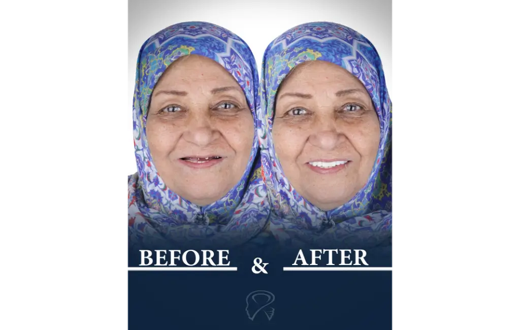 نمونه کار ایمپلنت در کلینیک بلودنت توسط دکتر باقری