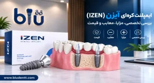ایمپلنت آیزن izen چیست؟