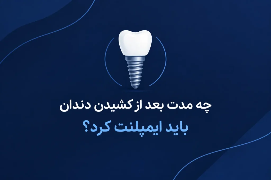 چه مدت بعد از کشیدن دندان باید ایمپلنت کرد؟