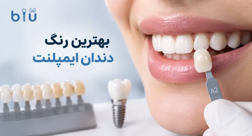 بهترین رنگ دندان ایمپلنت چیست؟